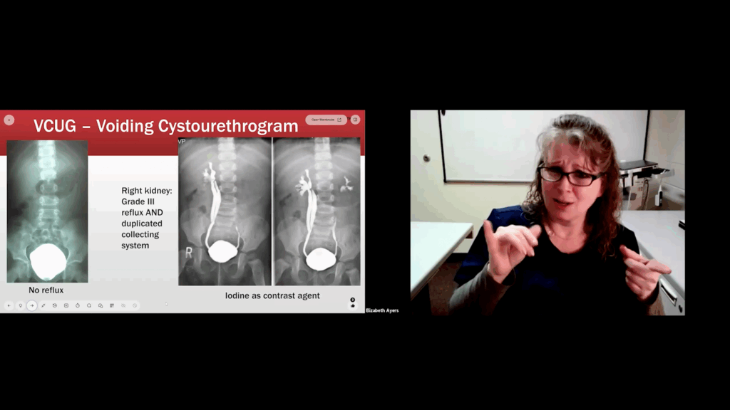 The image is a still from a medical lecture showing a woman speaking on the right and a presentation slide on the left. The slide is titled "VCUG – Voiding Cystourethrogram" and displays three X-ray images comparing a normal bladder (no reflux) to images where a contrast agent (iodine) reveals Grade III reflux and a duplicated collecting system in the right kidney.