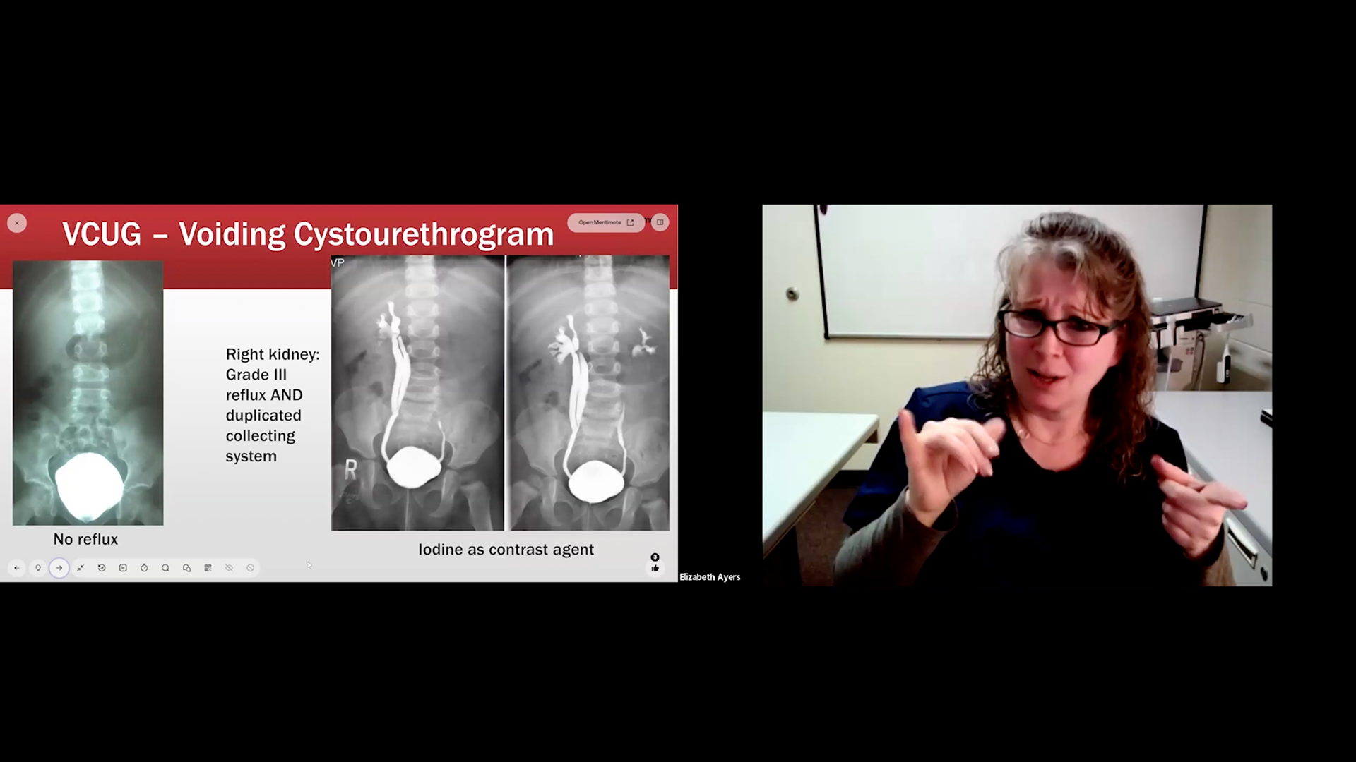 The image is a still from a medical lecture showing a woman speaking on the right and a presentation slide on the left. The slide is titled "VCUG – Voiding Cystourethrogram" and displays three X-ray images comparing a normal bladder (no reflux) to images where a contrast agent (iodine) reveals Grade III reflux and a duplicated collecting system in the right kidney.