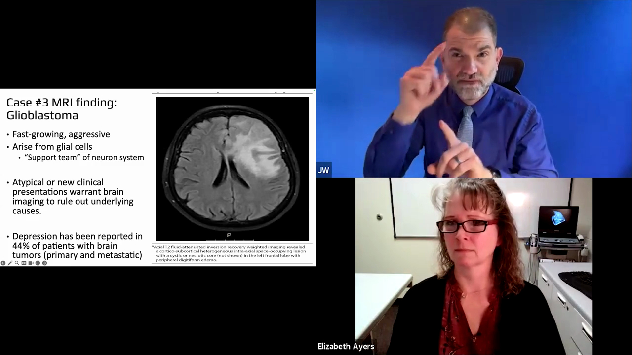 A multi-paneled presentation features a slide on the left detailing MRI findings for Glioblastoma, describing it as a fast-growing, aggressive tumor arising from glial cells. On the right, presenters Dr. Jaime Wilson and Elizabeth Ayers are shown in separate video feeds, with Dr. Wilson actively signing while Elizabeth listens from an office setting.