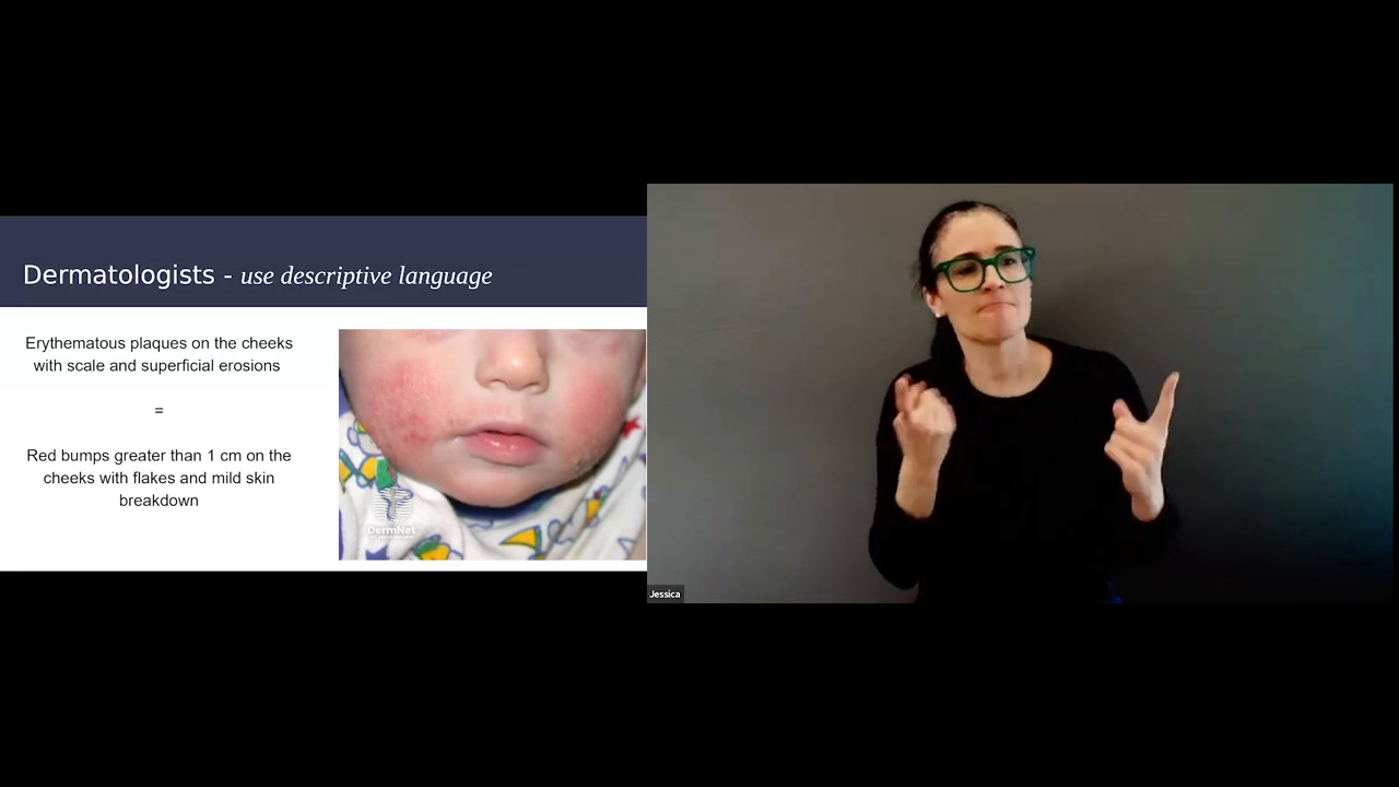 This image displays a split-screen interface featuring a presentation slide on the left and a presenter signing on the right. The presentation slide contrasts medical and plain-language descriptions alongside a photo of an infant's red, irritated cheeks, while the presenter wears green-rimmed glasses against a dark background.
